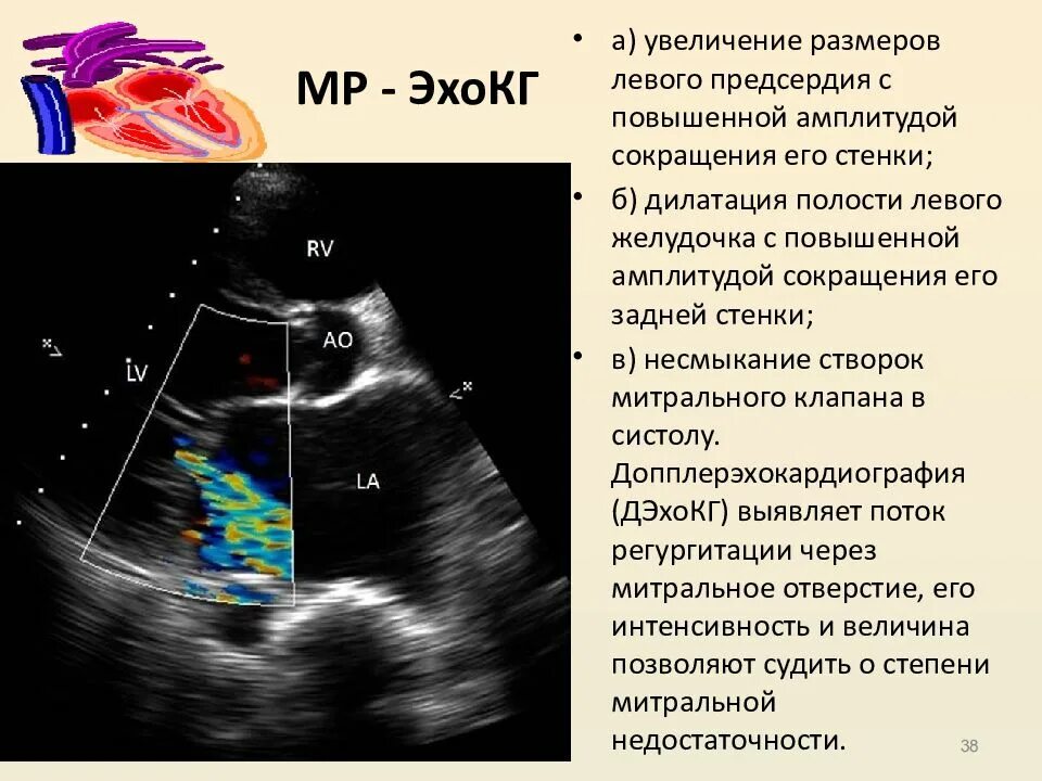 Как проходят эхо. УЗИ ЭХОКГ порока сердца. Дилатация ЛП на ЭХОКГ. Фиброз створок митрального клапана УЗИ. Объем левого предсердия ЭХОКГ.