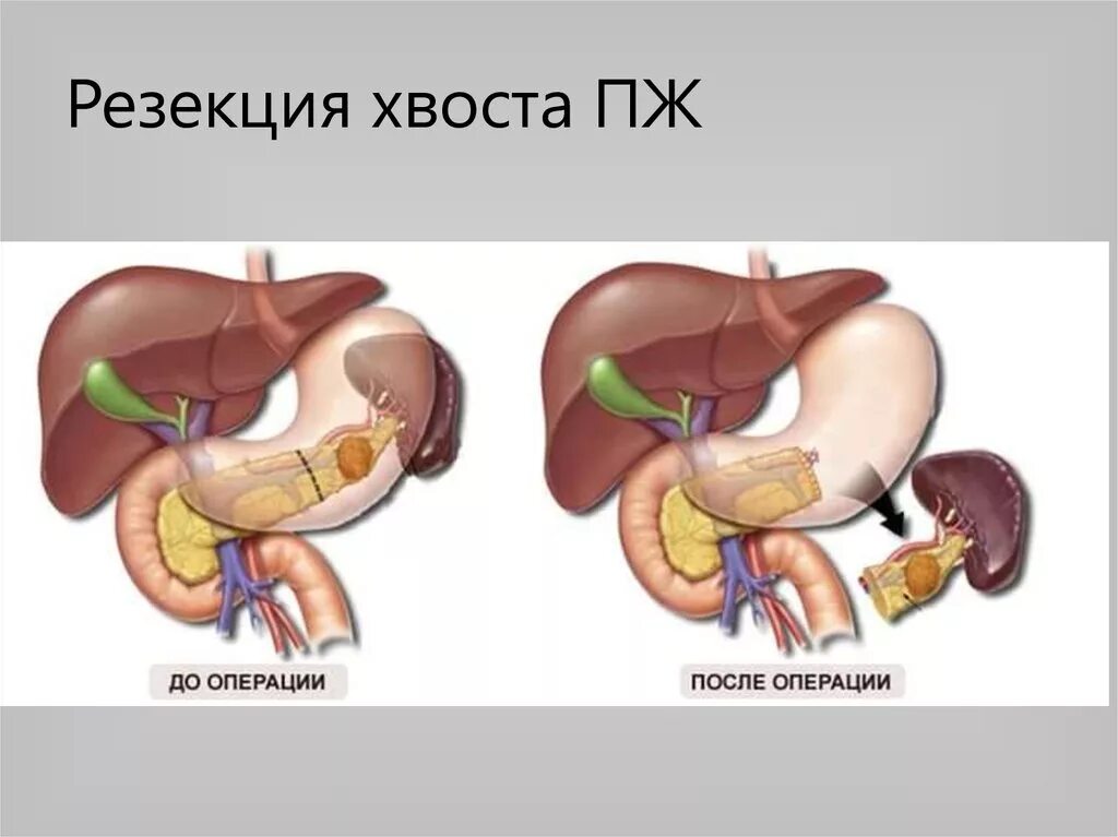 Селезенка тест. Спленэктомия операция. Панкреатодуоденальная резекция операция Whipple. Дистальная резекция поджелудочной железы этапы операции. Панкреатодуоденальная резекция ход операции.