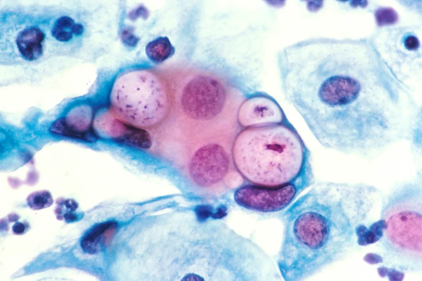Хламидия пситаци. Chlamydia trachomatis под микроскопом.