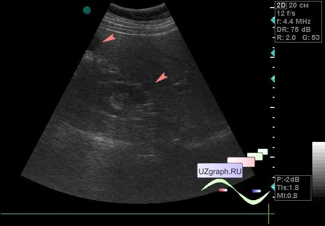 Сонография желчного пузыря. Сонография почек. Кальцинат в печени на узи