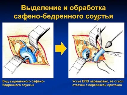 Сафено феморальное соустье