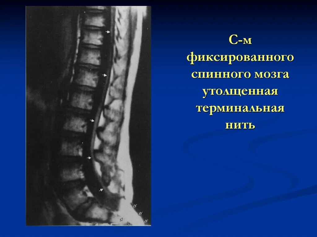 Утолщение терминальной нити спинного мозга мрт. Липома терминальной нити синдром фиксированного спинного мозга. Фиксированный конус спинного мозга. Фиксация терминальной нити спинного мозга.