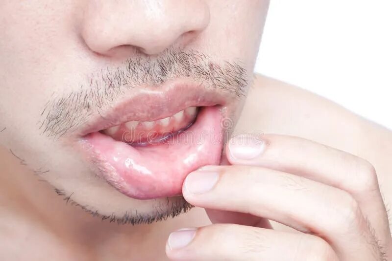Question 1 - Oral Manifestations Question Bank - National HIV Curriculum