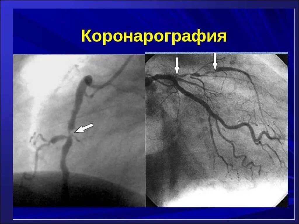 Атеросклеротическое поражение ствола коронарных артерий. Левая коронарная артерия ангиография. Острый инфаркт миокарда кт коронарография. Коронарные сосуды коронарография. Абляция пищевода