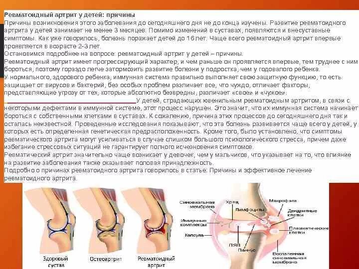 Ревматоидный артрит это. Ревматоидный артрит причины возникновения. Причины развития артрита. Ревматоидный артрит факторы возникновения. Ревматический артрит причины.