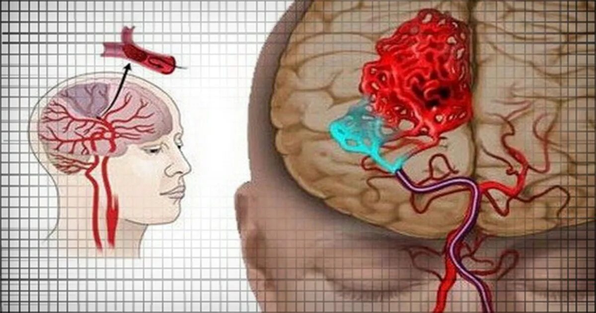 Тромбы после инсульта. Ишемический инсульт сосудов головного мозга. Тромбоэмболия сосудов головного мозга. Ишемический инсульт поражения артерий.