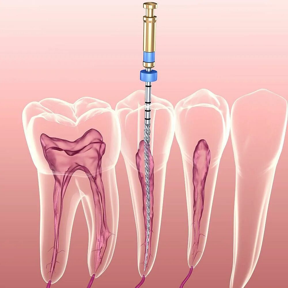 Эндодонтия в стоматологии. Этапы эндодонтического лечения