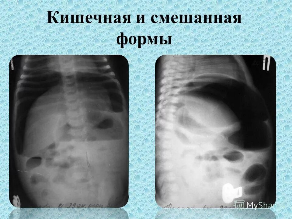 муковисцидоз кишечная форма патогенез. муковисцидоз легочно кишечная форма. легочно кишечный. муковисцидоз легочно кишечная форма. муковисцидоз клинические признаки.
