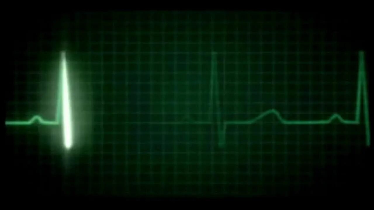 Пульс остановился. Кардиограмма сердца. Кардиограмма остановки сердца. Остановка сердца на ЭКГ. Пульс остановка сердца.