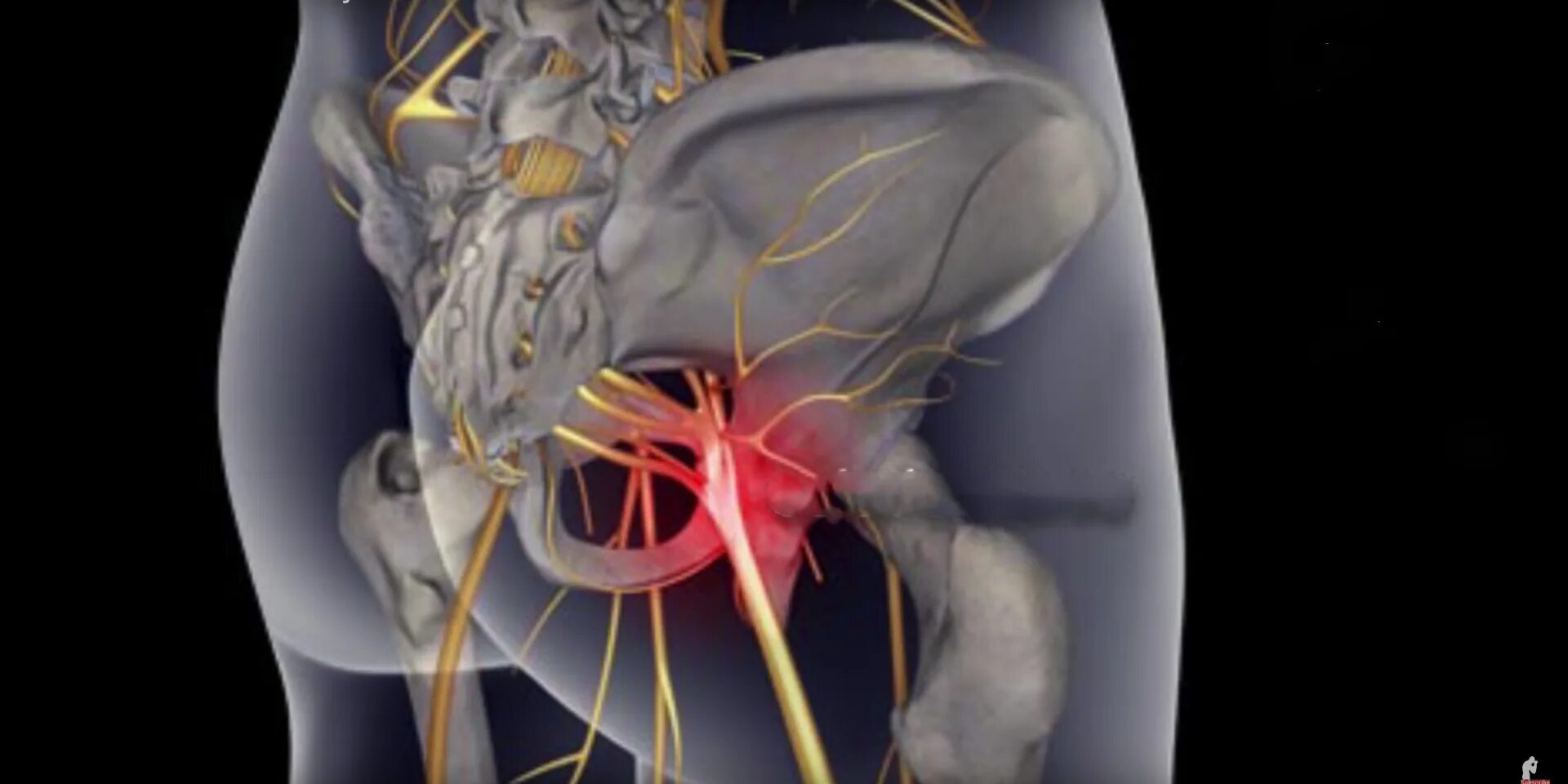 Сильные боли седалищного нерва. Ишиас - защемление седалищного нерва. Поражение нерва седалищного анатомия. Анатомия седалищного нерва у человека. Седалищный нерв МСКТ.