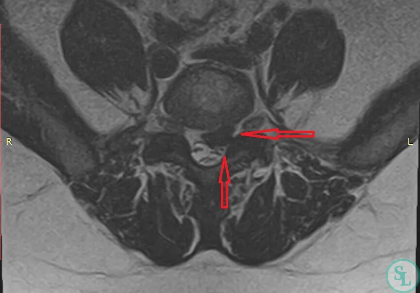 Иррадиация в ногу. Грыжа l5-s1. Грыжа диска l5-s1. L5-s1 межпозвонковая грыжа. Диск l5-s1.
