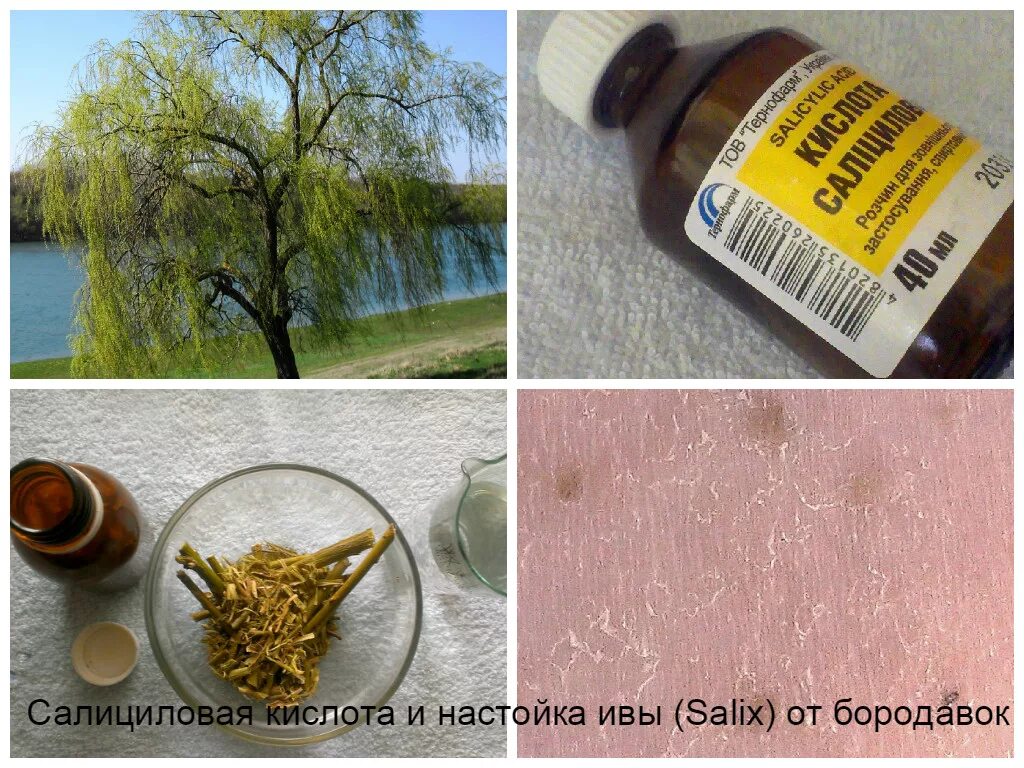 Как удалить бородавку народными средствами