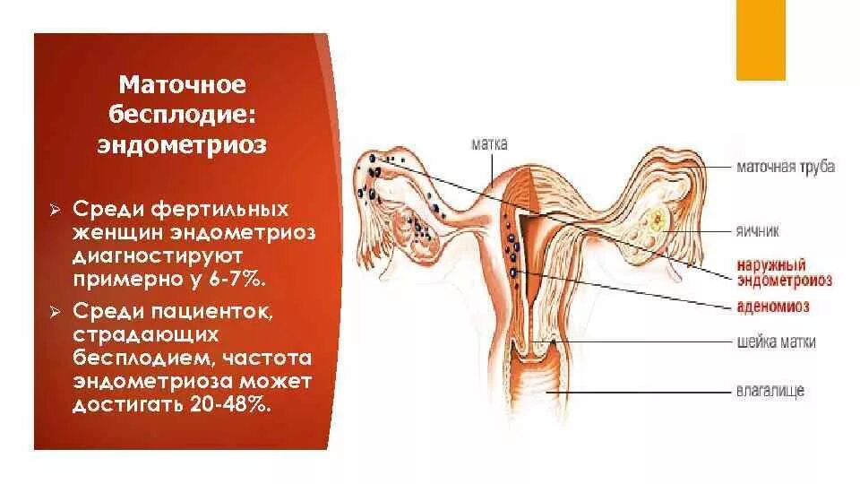 Маточная форма бесплодия. Эндометриоз матки это бесплодие?. Бесплодие маточного происхождения. Маточное бесплодие