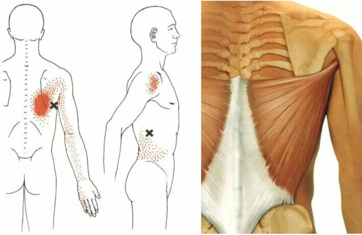 Точки на пояснице. Триггерные точки широчайшей мышцы спины. Передняя зубчатая мышца триггерные точки. Миофасциальный синдром передней зубчатой мышцы. Миофасциальный синдром триггерные точки.