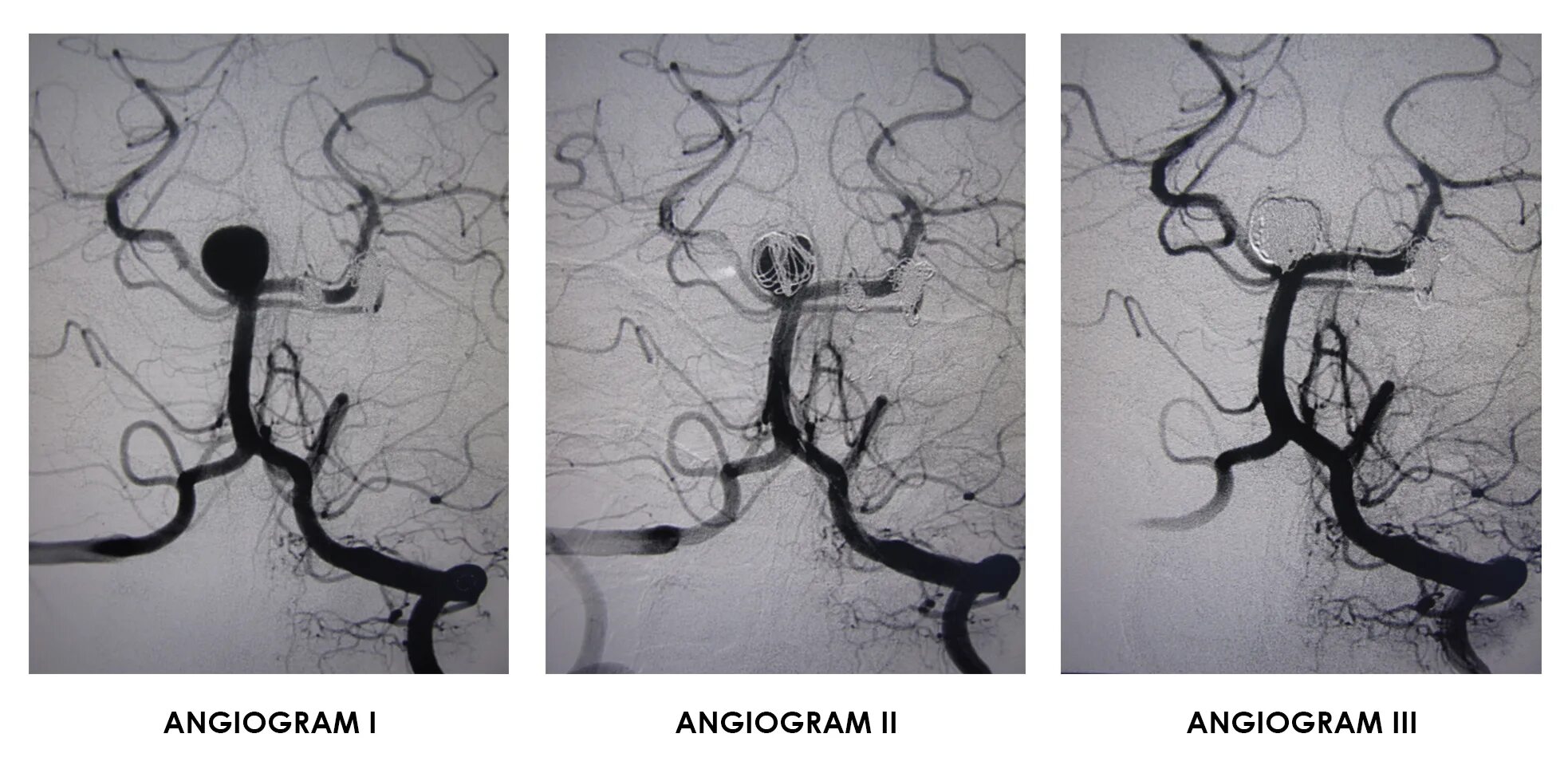 Эндоваскулярная операция аневризмы головного. Эндоваскулярная эмболизация аневризмы головного мозга. Эндоваскулярная эмболизация аневризм сосудов головного мозга.. Артериальные аневризмы эмболизация. Эмболизация аневризмы задней мозговой артерии.