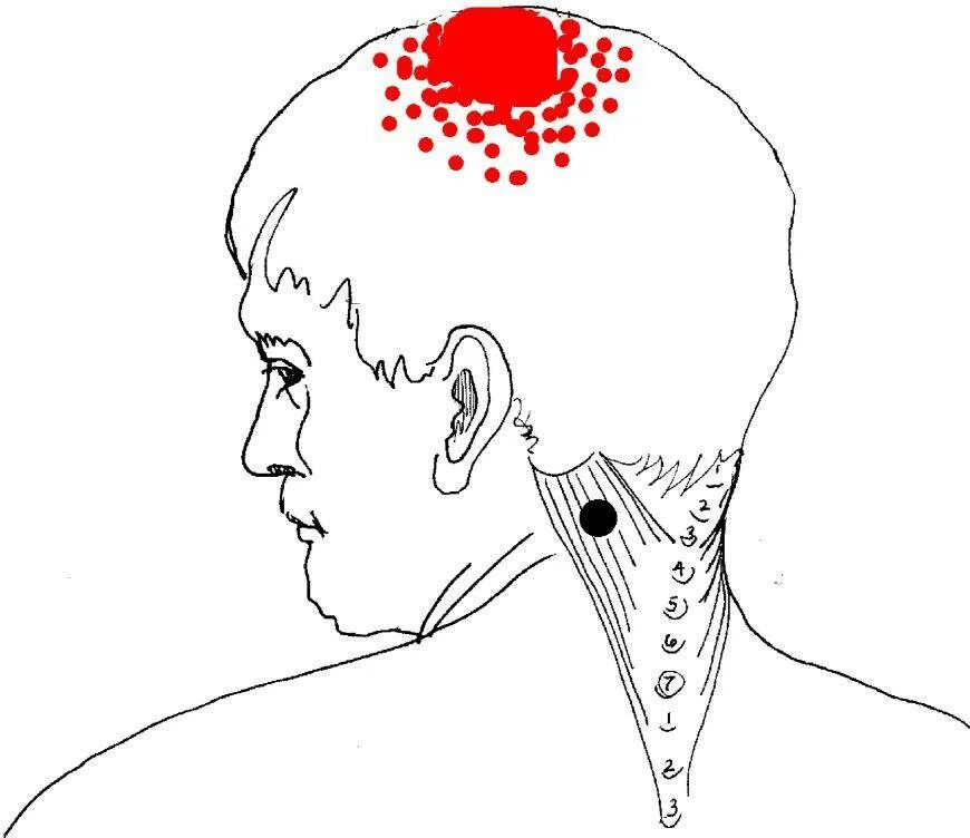 Голова левая сторона затылок. Триггерные точки при головной боли. Триггерная точка боли в затылке. Болит на затылке воднгй точуе. Точки на темени головы.