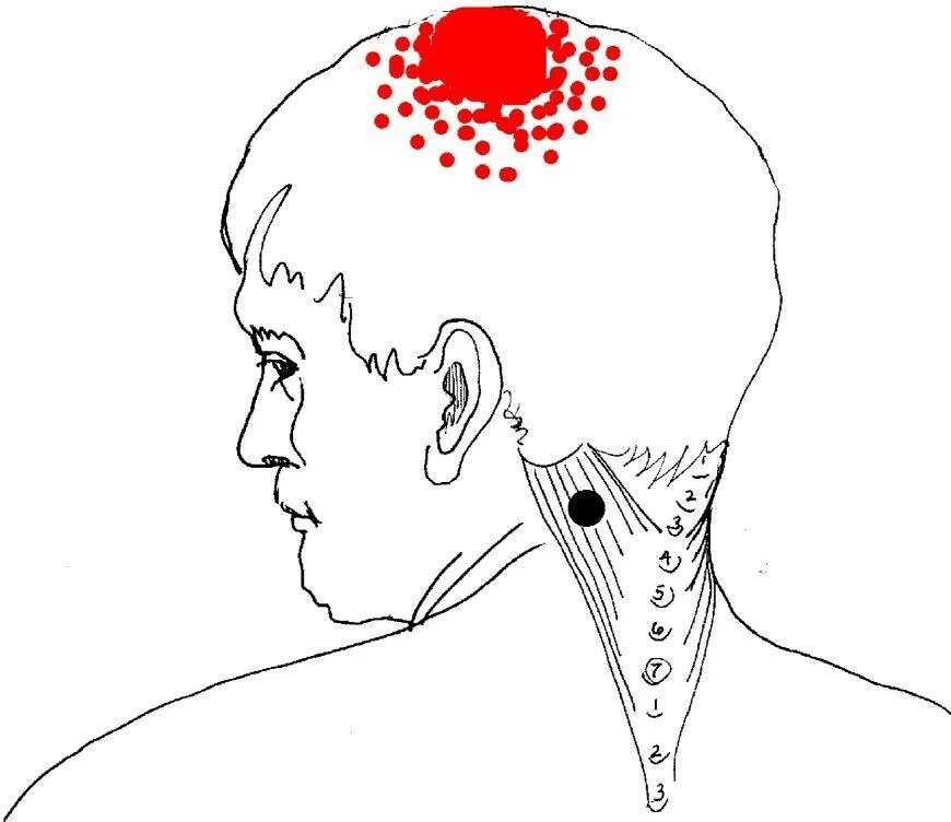 Триггерные точки при головной боли. Триггерная точка боли в затылке. Болит на затылке воднгй точуе. Точки на темени головы.
