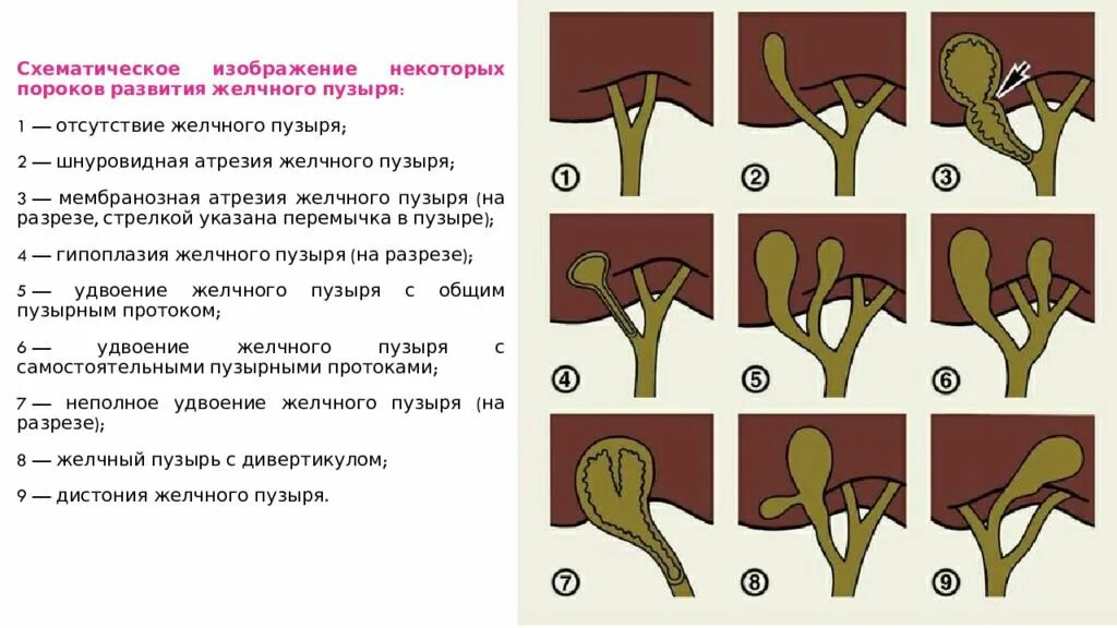 Аномалии развития желчных протоков. Аномалии положения желчного пузыря. Врожденные аномалии желчного пузыря. Желчный пузырь в форме фригийского колпака.