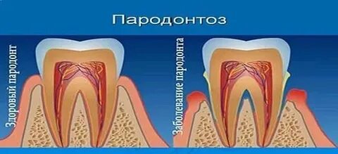 Сигареты пародонтоз