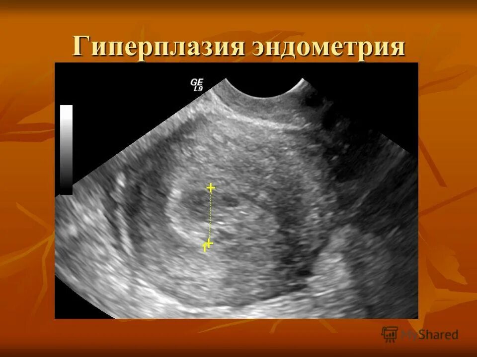 Кистозно расширенная железа. Эхограмма гиперплазии эндометрия. Гиперплазия эндометрия на УЗИ.