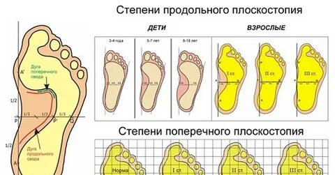 Как увеличить степень плоскостопия