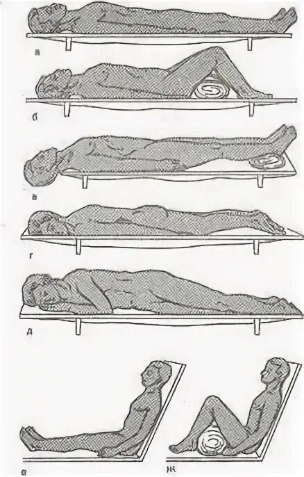 Транспортировка пострадавшего при ранением конечностей. Транспортировка пораженного при переломе. Положения при транспортировке пострадавших при различных травмах. Положение пострадавшего при повреждении позвоночника