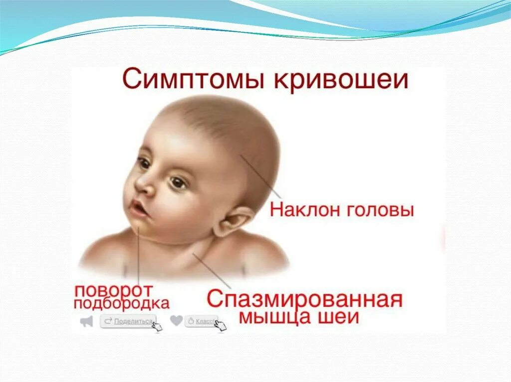 Кривошея у новорожденного