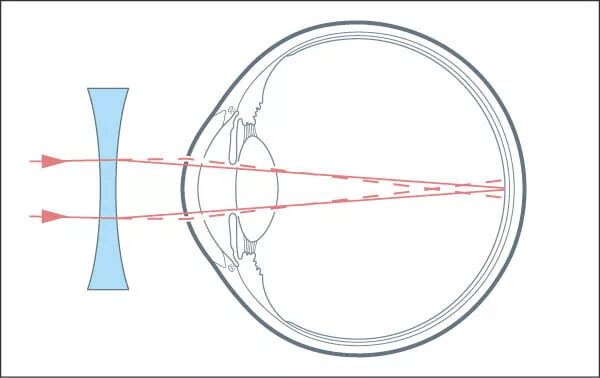 Дальнозоркость линзы двояковыпуклые. Линзы для коррекции миопии. Линзы для близорукости и дальнозоркости физика. Линзы для коррекции миопии (близорукости). Линзы для глаз для зрения миопия.