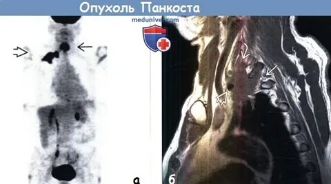 Рак панкоста
