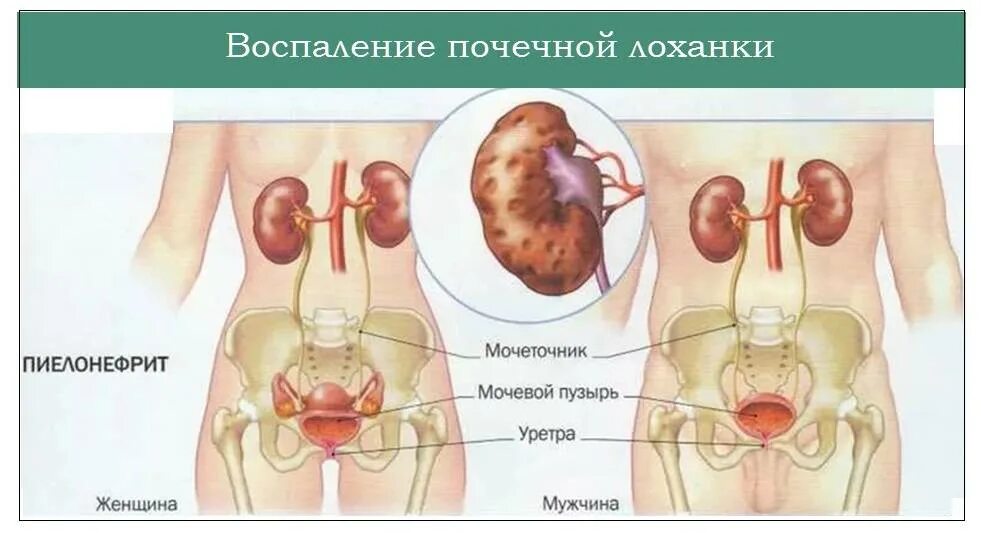 Как болят мочеточники симптомы. Мочекаменная болезнь хронический пиелонефрит. Хронический пиелонефрит вид почки. Острый и хронический пиелонефрит симптомы. Пиелонефрит поражение почечной лоханки.