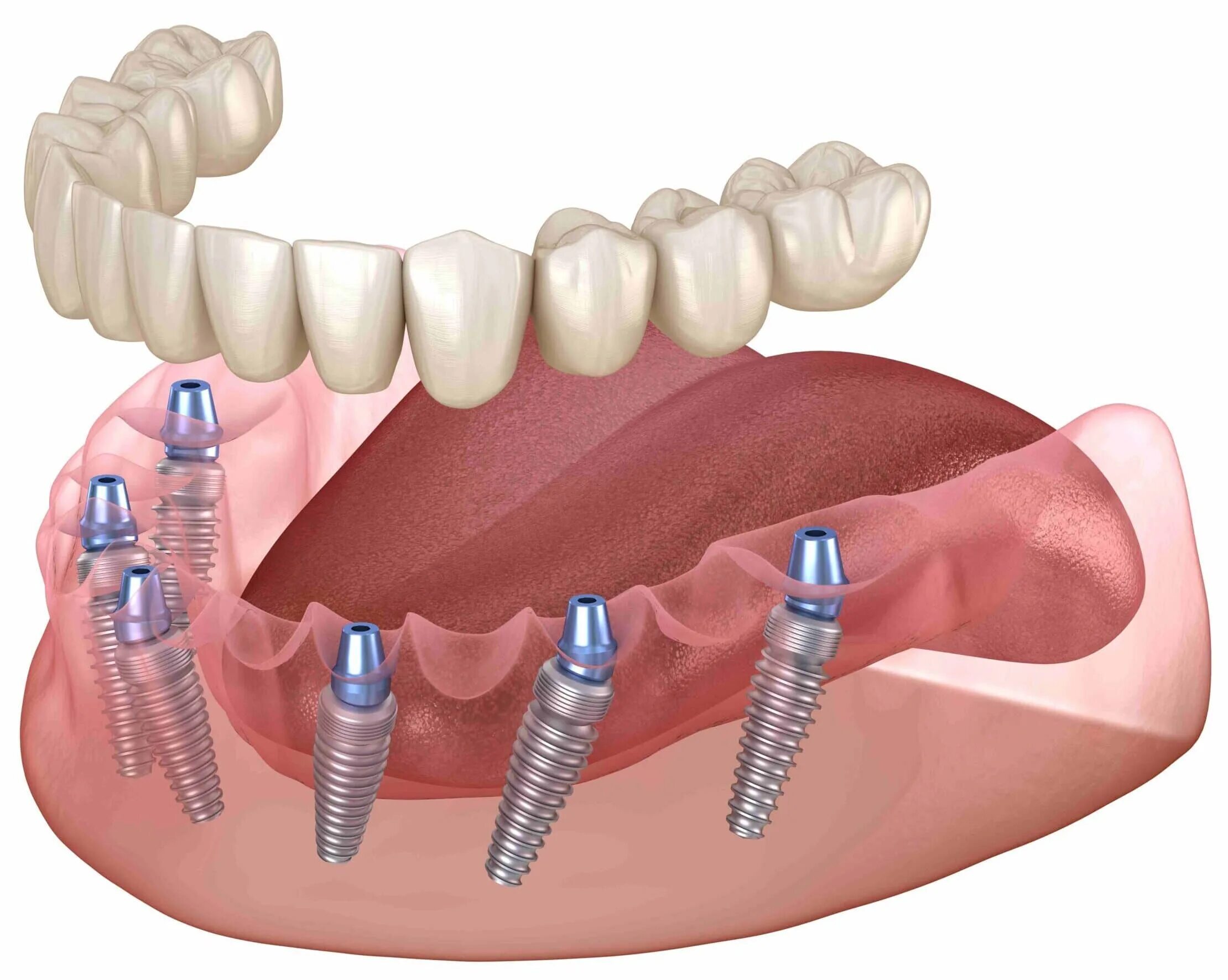 Имплантация "all on 6" Nobel Biocare (США-Швеция). Имплантация челюсти на 6 имплантах. Балочный протез на 4 имплантах. Имплантация зубов all on 6.