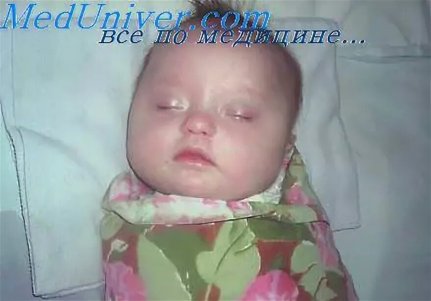 Новорожденные дети с синдромом Дауна. Новорожденные с синдромом Дауна. Синдром Дауна у новорожденных. Роды дауна