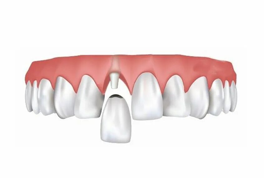 Core crowns
