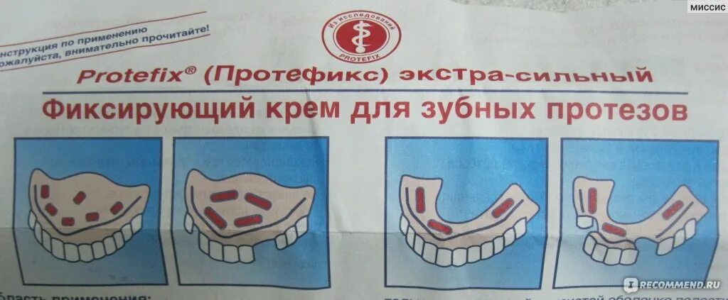 Как правильно наносить крем на зубные протезы. Нанесение корега на протез. нанесение крема корега на нижний протез. нанесение фиксирующего крема на зубной протез. корега для зубных протезов схема нанесения.
