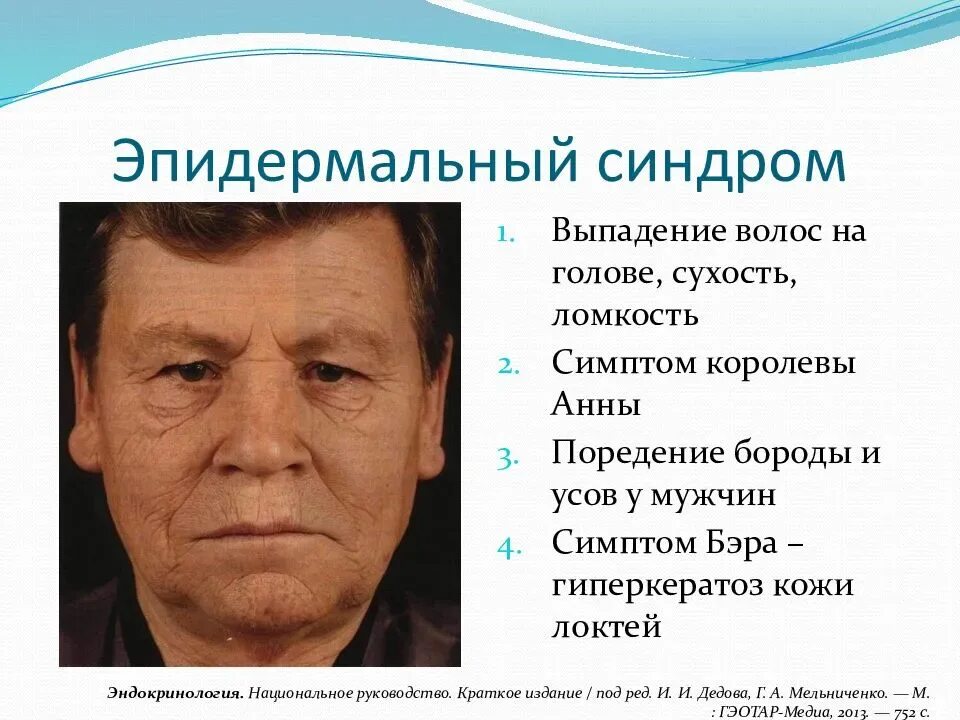 Симптом королевы Анны. Эпидермальный синдром. Авиадермальный синдром. Синдром королевы Анны.