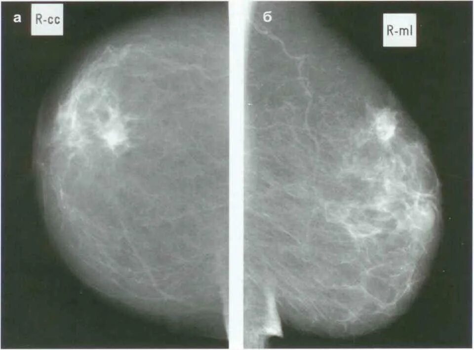 Маммография фиброаденома. Узловая мастопатия молочной железы маммография. Фиброаденома молочной железы маммография. Фиброзно-кистозная мастопатия снимок. Онкология молочных желез симптомы
