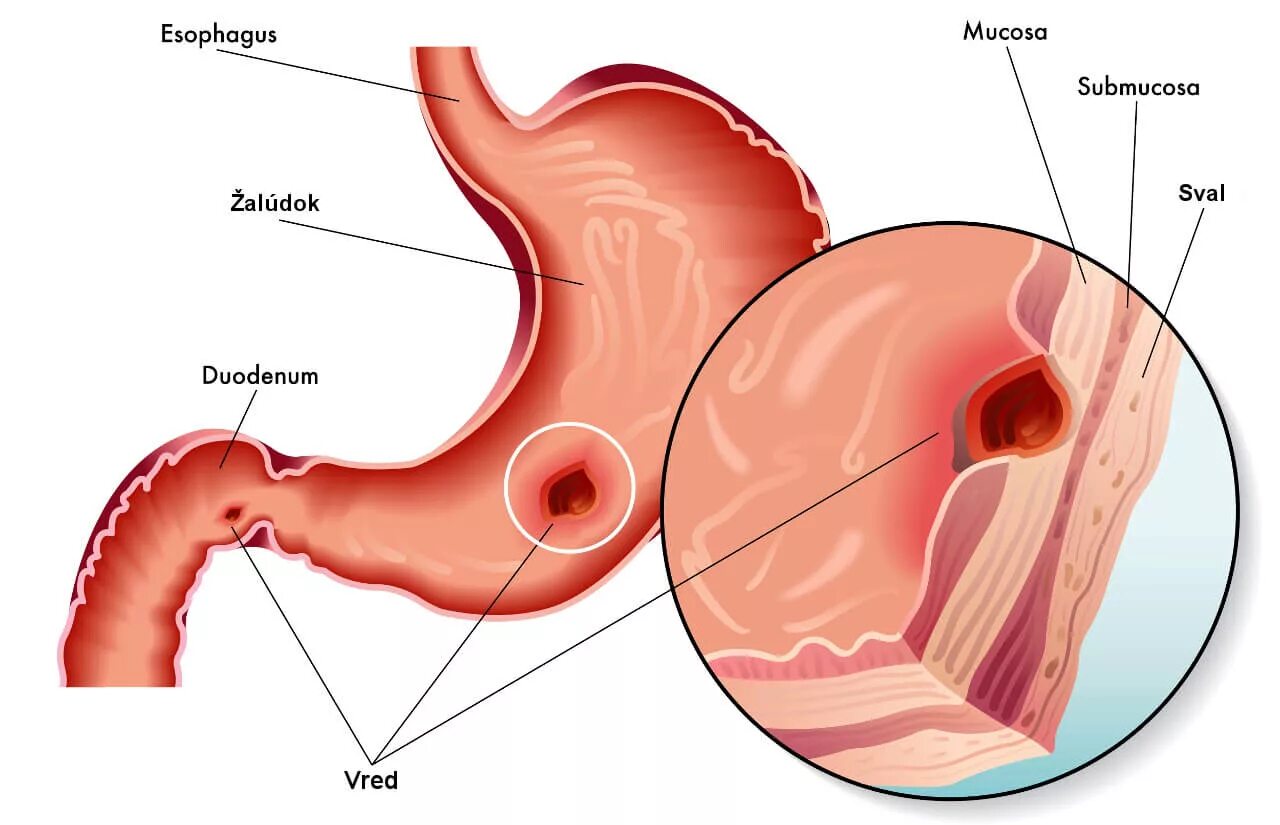 Язвенная болезнь ДПК ФГДС. Язвенная болезнь желудка язвенная болезнь 12 перстной кишки. Язвенная болезнь желудка и 12пк. Язва двенадцатиперстной кишки ФГДС. Как проверить язву
