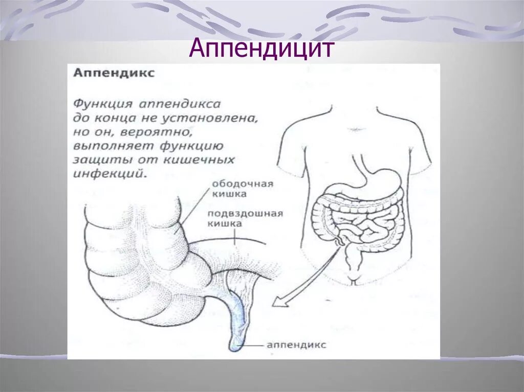 Аппендицит тест с ответами