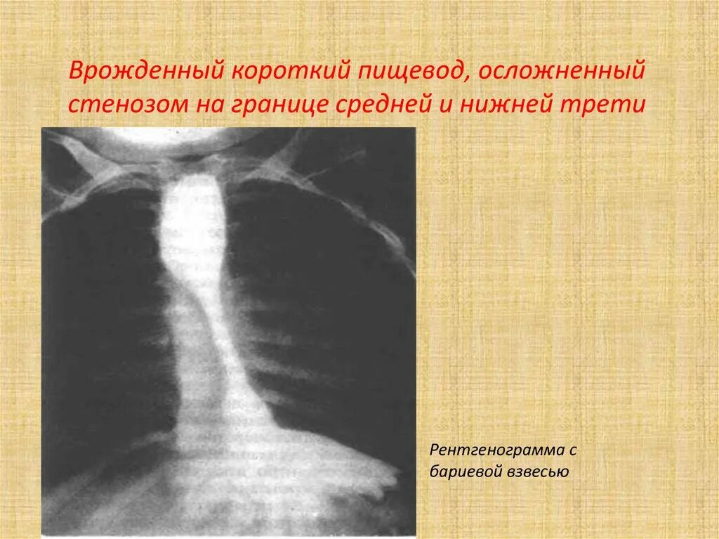 Врожденный короткий пищевод. Короткий пищевод (врожденная аномалия). Врожденный короткий пищевод рентген. Короткий пищевод рентген.