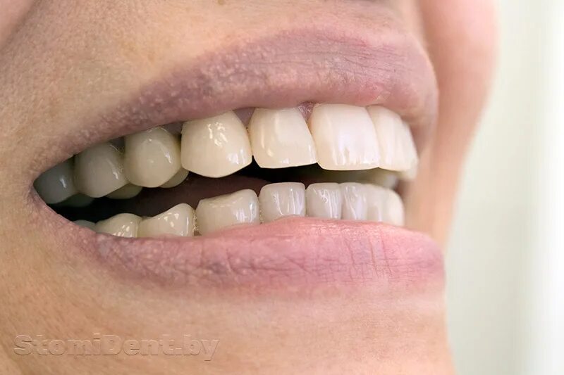 коронки диоксид циркония преимущества. диоксид циркония ортопедическая стоматология. металлокерамическая коронка на зуб. металлокерамика отзывы. металлокерамическая коронка а1 120.