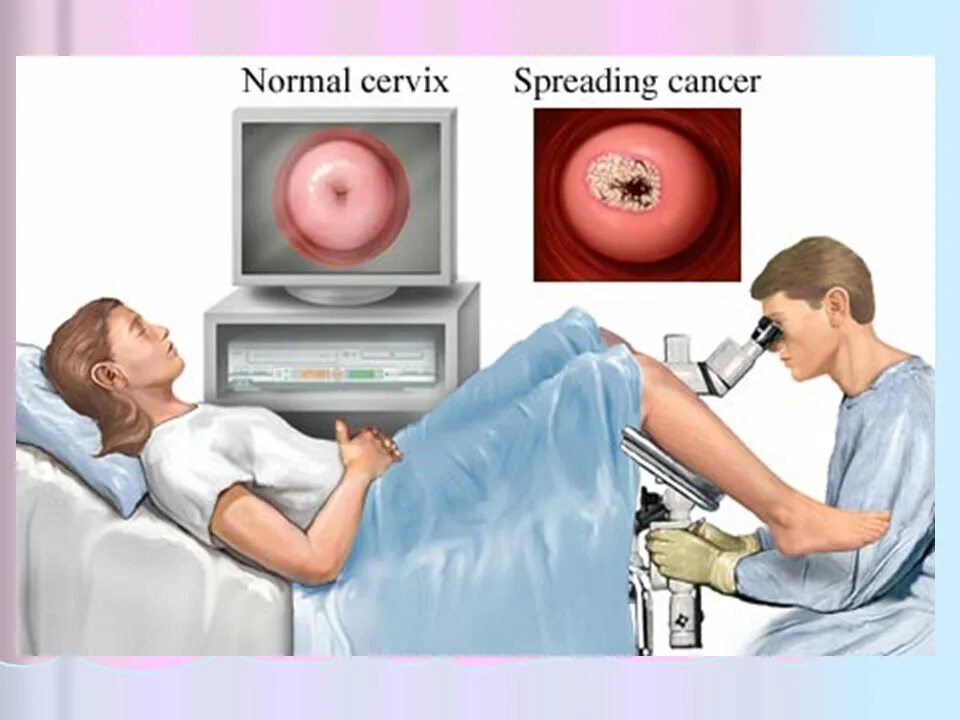 Гинеколог помогает забеременеть. Эктопия шейки кольпоскопия. Эрозия шейки матки кольпоскопия. Кольпоскопия проба Шиллера.