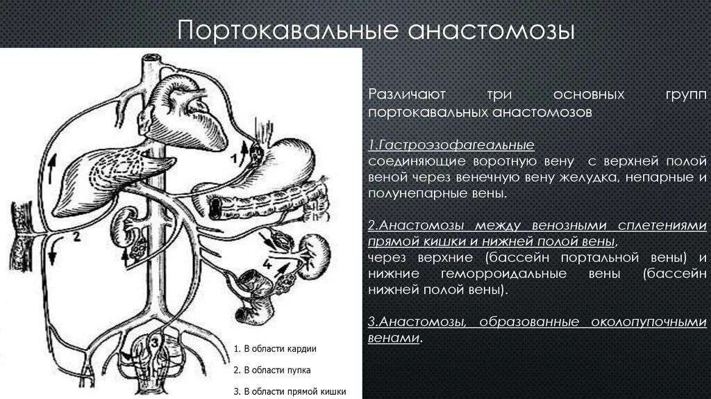 Значение кава кавальных анастомозов. Пути коллатерального кровообращения при портальной гипертензии. портальная вена печени анастомоз. портокавальные анастомозы. портр кавальные анастомозы.