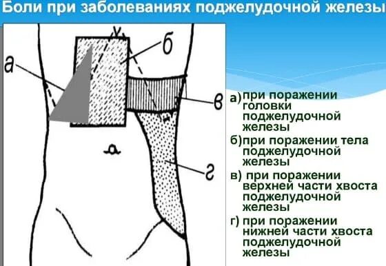 Поджелудочная боль в спине. Локализация боли поджелудочной железы. Боли от поджелудочной железы отдают. Куда отдает боль при поджелудочной железе. Локализация боли при панкреатите.