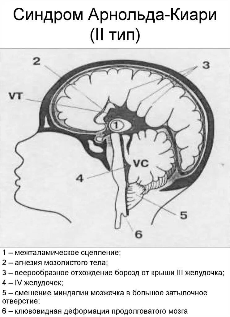 Мальформация Арнольда-Киари 2 типа. Типы мальформации Арнольда Киари. Аномалия Арнольда Киари 2 типа мрт. Синдром Арнольда-Киари 1 типа.