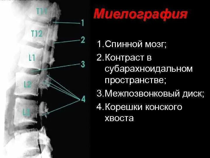 Задние столбы спинного. Миелография сколиоза. Миелография позвоночника что это такое. Кт миелография позвоночника. Миелография спинного мозга.
