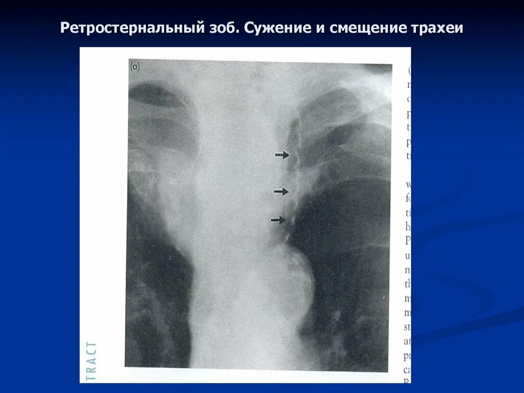 Обызвествление щитовидной железы на рентгене. Смещение трахеи на рентгене. Зоб щитовидной железы рентген. Пищевод зоб