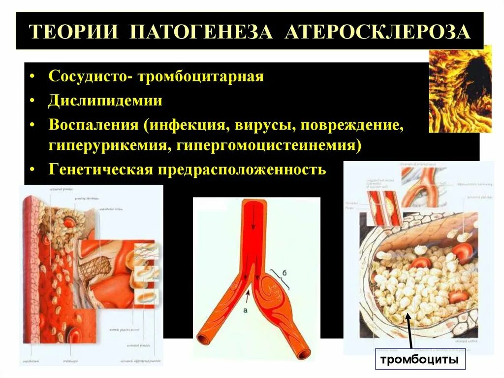 Ибс стенокардия атеросклероз. Дислипидемия атеросклероз этиология. атеросклероз и дислипидемия. этиология атеросклероза. классификация атеросклероза.