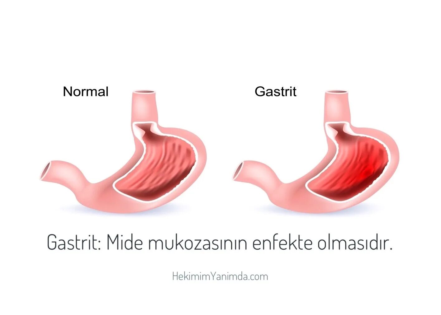 Гастрит смп