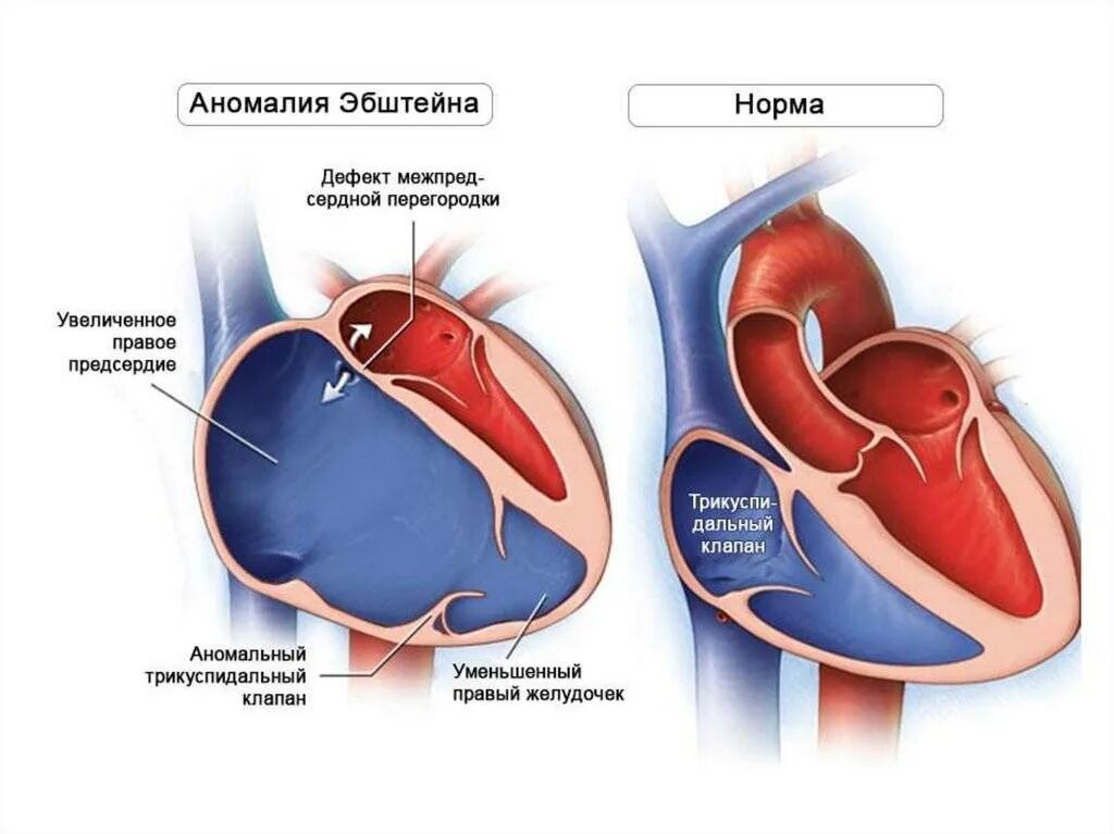 Предсердие болезни. Врожденный порок сердца Эпштейна. Синдром Эпштейна сердце. Синдром Эбштейна у детей.