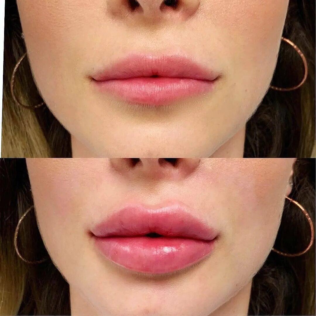 Аугментация губ гиалуроновой кислотой. Губы моны Лизы гиалуроновой кислотой. Увеличенные губы красивые. Как отличить губы